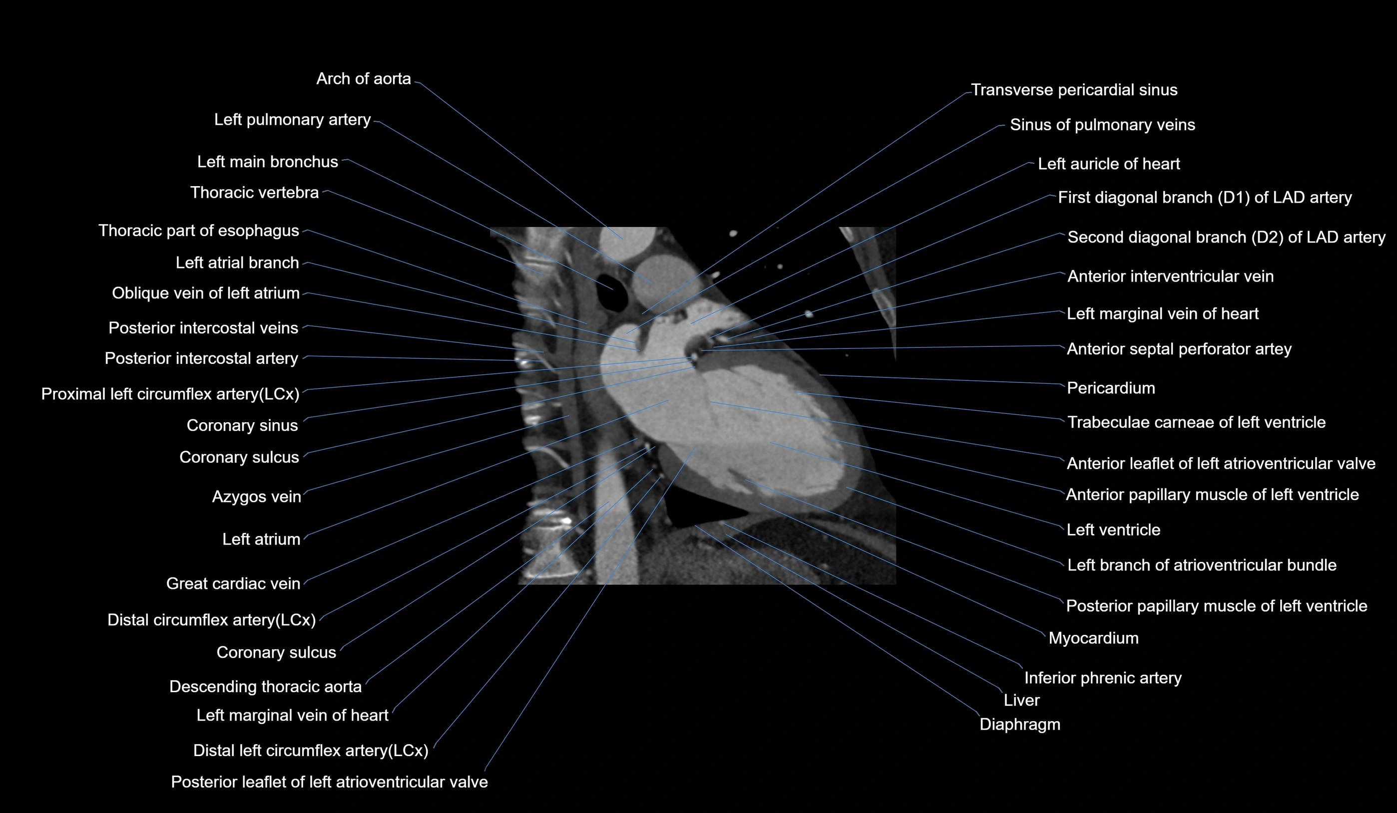 CT heart (coronary angiogram) 2 chamber view cross sectional anatomy labelled radiology image-00013.webp